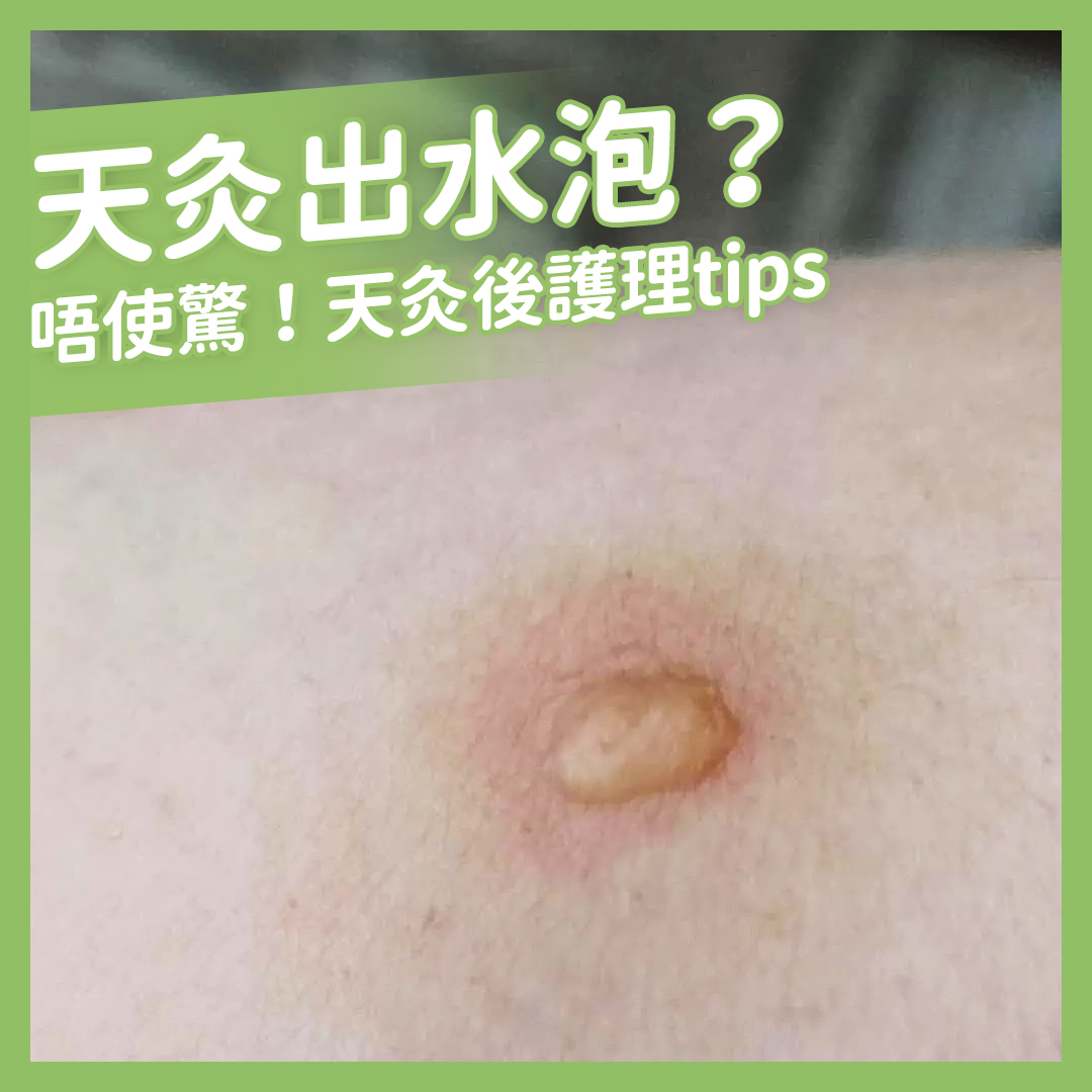 天灸後出水泡點算好 !? | 天灸後護理 | alfalfamedical .com